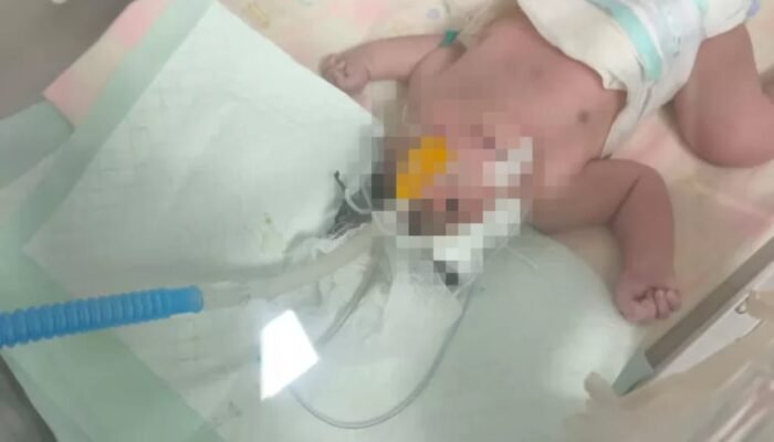 Lahir Tanpa Tempurung Kepala, Bayi Malang Ini Butuh Uluran Tangan